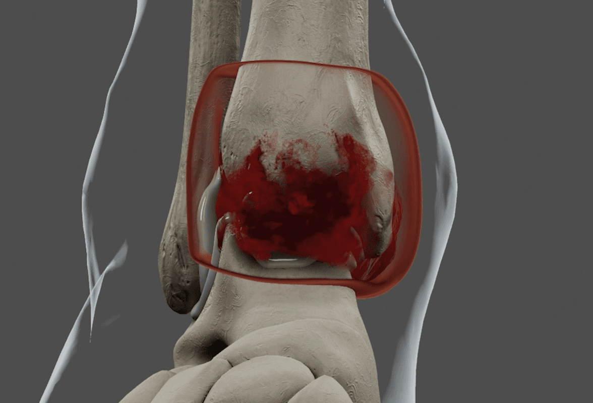 3D medical animation of ankle joint